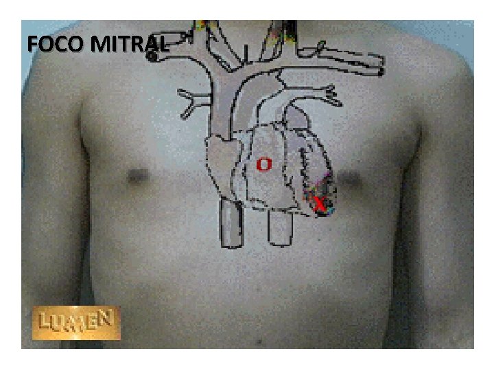 FOCO MITRAL 