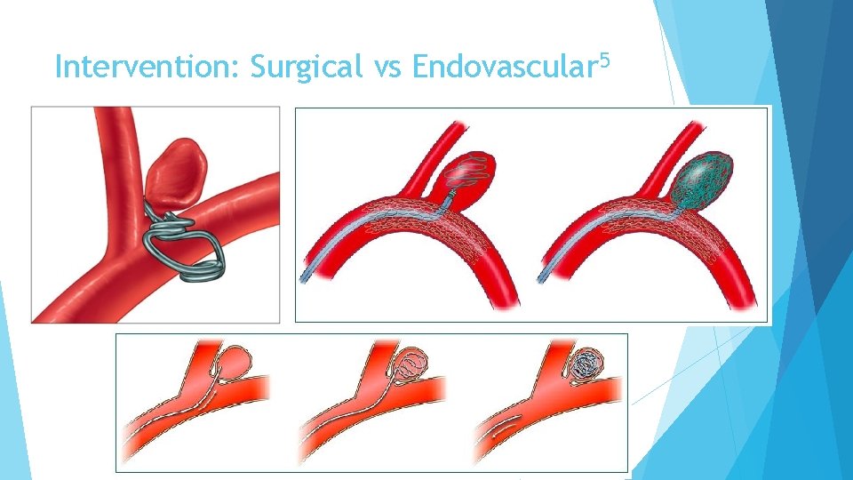 Intervention: Surgical vs Endovascular 5 