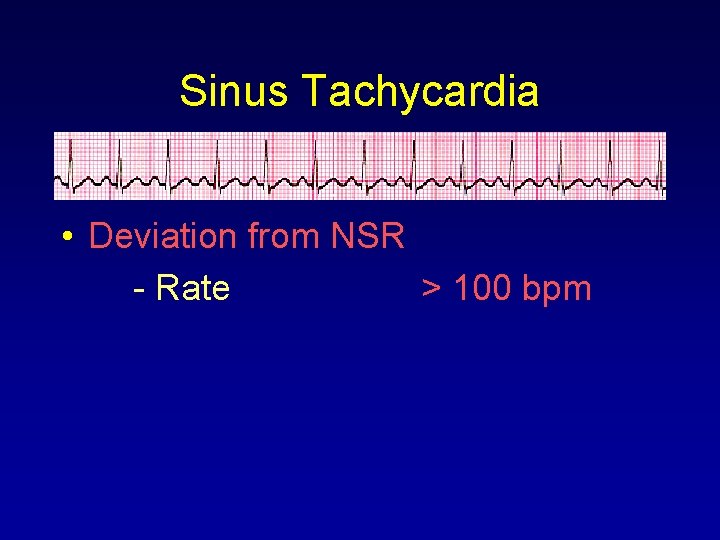 Sinus Tachycardia • Deviation from NSR - Rate > 100 bpm 