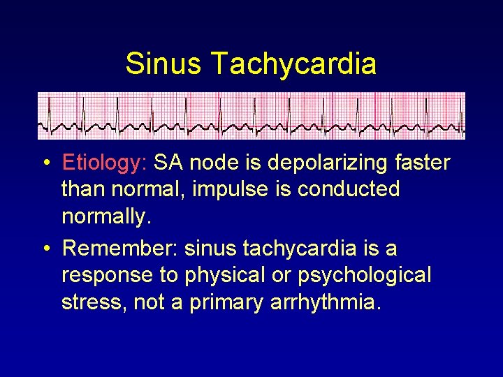 Sinus Tachycardia • Etiology: SA node is depolarizing faster than normal, impulse is conducted