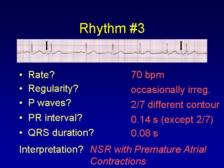Rhythm #3 • • • Rate? Regularity? P waves? PR interval? QRS duration? 70
