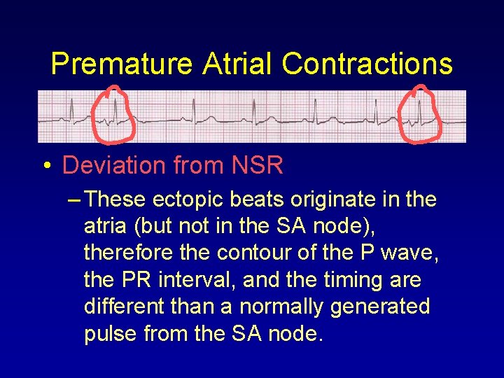 Premature Atrial Contractions • Deviation from NSR – These ectopic beats originate in the