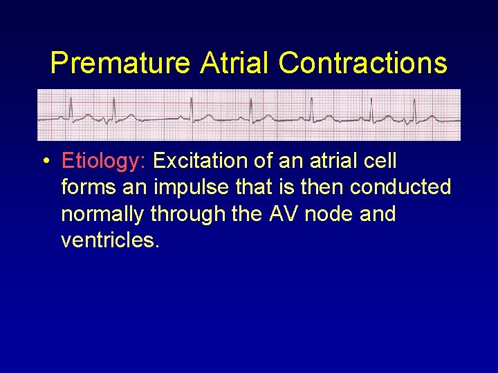 Premature Atrial Contractions • Etiology: Excitation of an atrial cell forms an impulse that