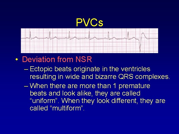 PVCs • Deviation from NSR – Ectopic beats originate in the ventricles resulting in