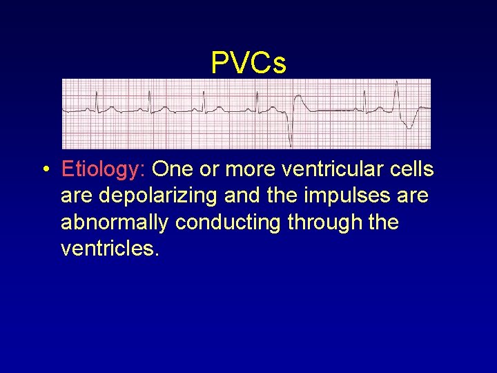 PVCs • Etiology: One or more ventricular cells are depolarizing and the impulses are