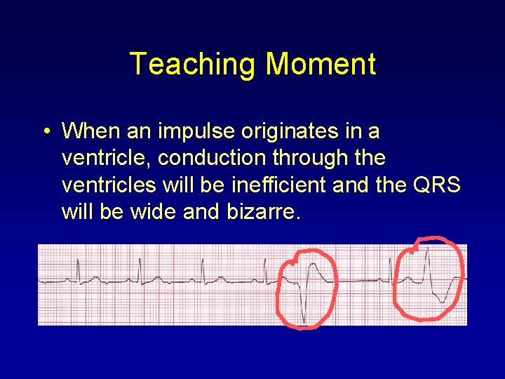 Teaching Moment • When an impulse originates in a ventricle, conduction through the ventricles