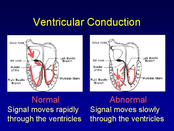Ventricular Conduction Normal Abnormal Signal moves rapidly through the ventricles Signal moves slowly through