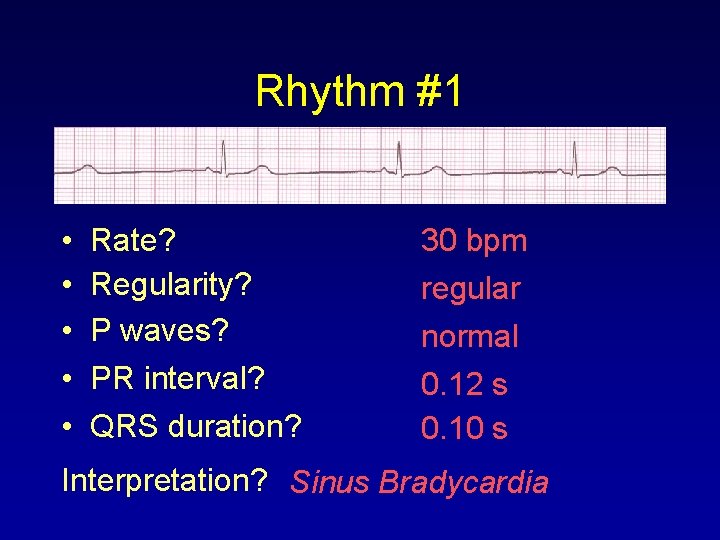 Rhythm #1 • • • Rate? Regularity? P waves? PR interval? QRS duration? 30