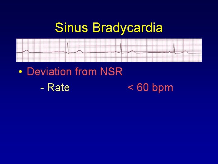 Sinus Bradycardia • Deviation from NSR - Rate < 60 bpm 