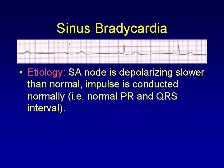 Sinus Bradycardia • Etiology: SA node is depolarizing slower than normal, impulse is conducted