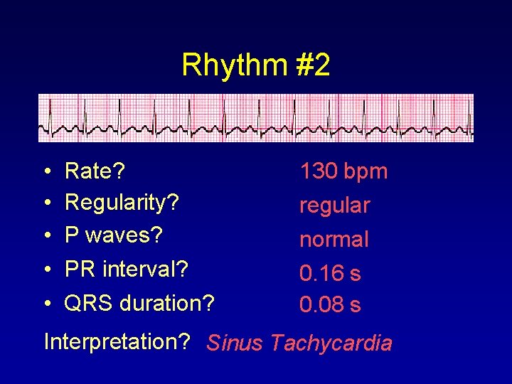 Rhythm #2 • • • Rate? Regularity? P waves? PR interval? QRS duration? 130