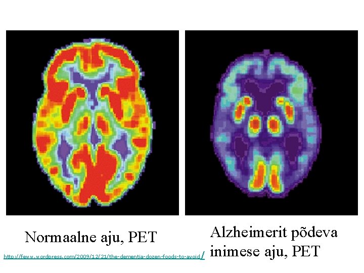 Normaalne aju, PET http: //feww. wordpress. com/2009/12/21/the-dementia-dozen-foods-to-avoid / Alzheimerit põdeva inimese aju, PET 