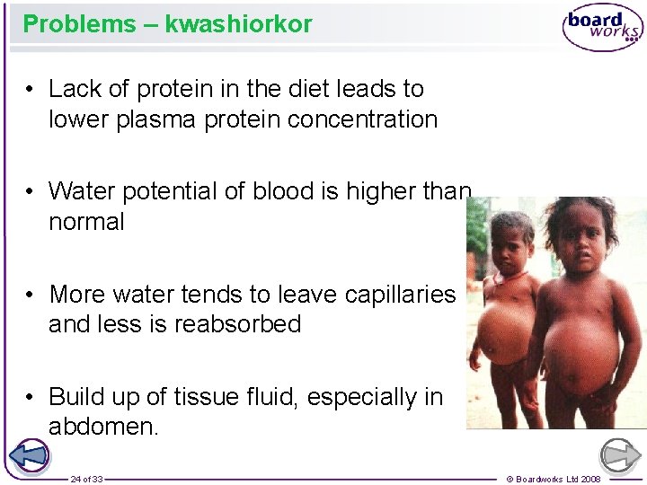 Problems – kwashiorkor • Lack of protein in the diet leads to lower plasma