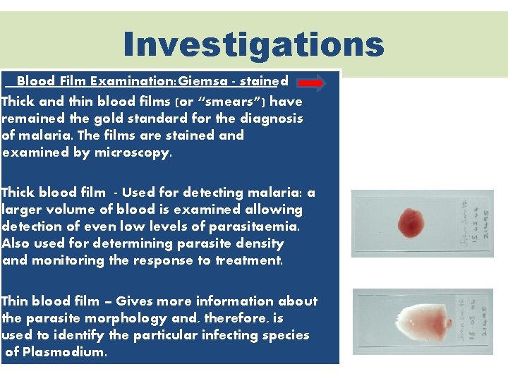 Investigations Blood Film Examination: Giemsa - stained Thick and thin blood films (or “smears”)