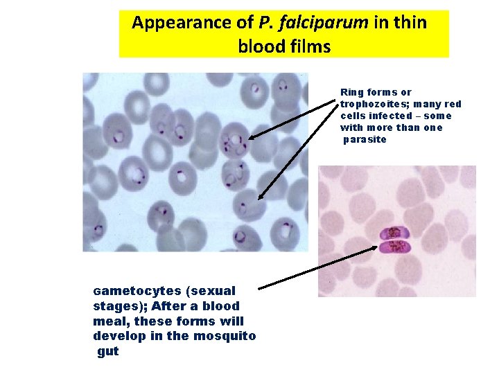 Appearance of P. falciparum in thin blood films Ring forms or trophozoites; many red