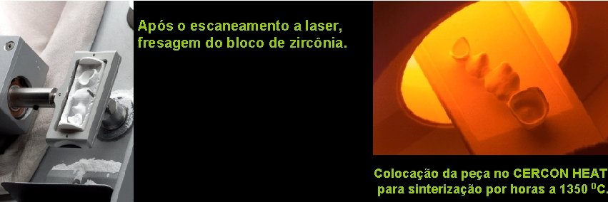 Após o escaneamento a laser, fresagem do bloco de zircônia. Colocação da peça no