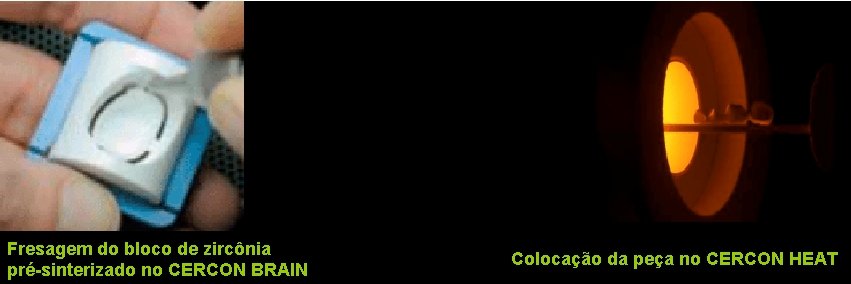 Fresagem do bloco de zircônia pré-sinterizado no CERCON BRAIN Colocação da peça no CERCON
