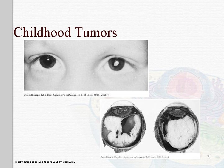 Childhood Tumors 19 Mosby items and derived items © 2006 by Mosby, Inc. 