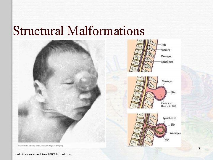 Structural Malformations 7 Mosby items and derived items © 2006 by Mosby, Inc. 