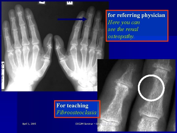 for referring physician Here you can see the renal osteopathy. For teaching Fibroosteoclasia April