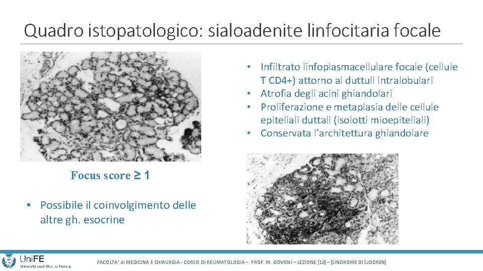 Quadro istopatologico: sialoadenite linfocitaria focale • Infiltrato linfoplasmacellulare focale (cellule T CD 4+) attorno