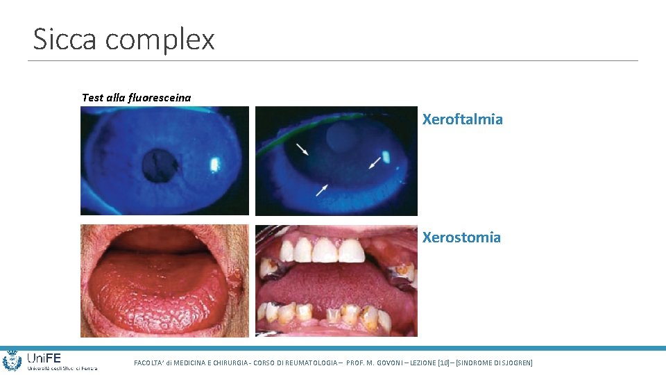 Sicca complex Test alla fluoresceina Xeroftalmia Xerostomia FACOLTA’ di MEDICINA E CHIRURGIA - CORSO