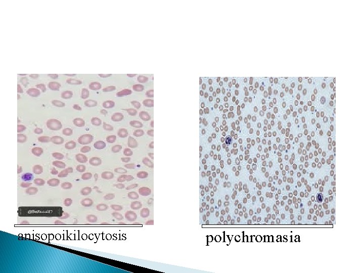 anisopoikilocytosis polychromasia 