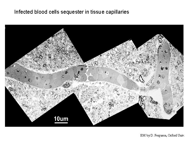 Infected blood cells sequester in tissue capillaries EM by D. Ferguson, Oxford Univ. 