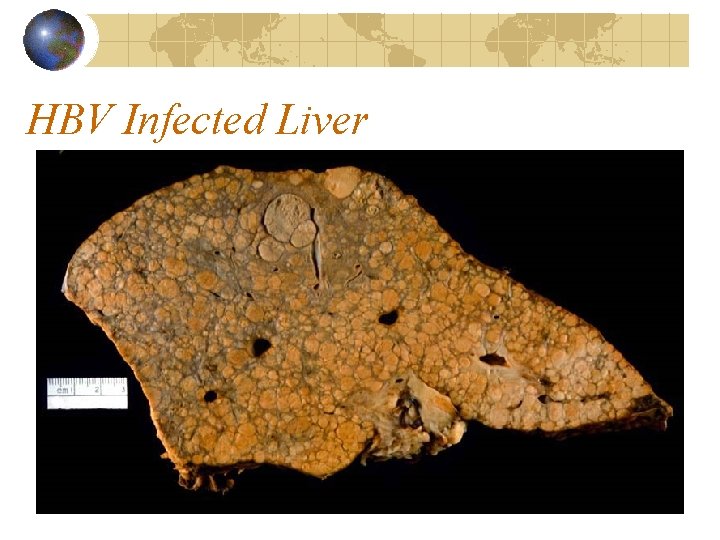 HBV Infected Liver 