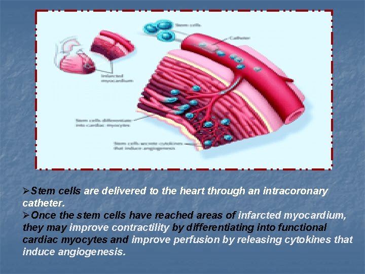 ØStem cells are delivered to the heart through an intracoronary catheter. ØOnce the stem