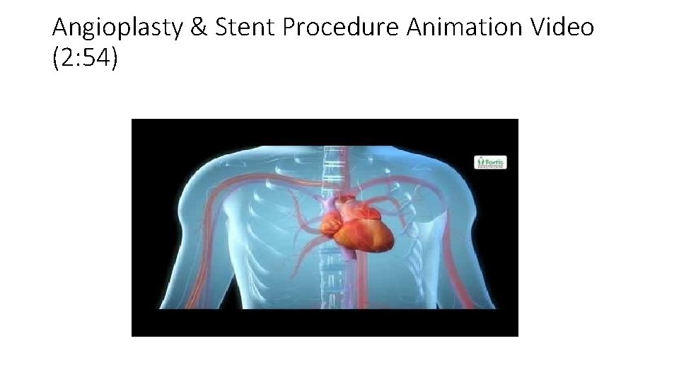 Angioplasty & Stent Procedure Animation Video (2: 54) 