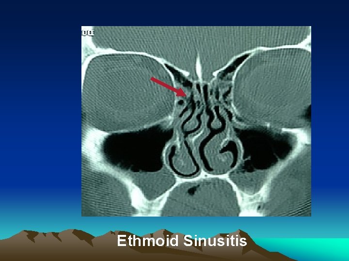 Ethmoid Sinusitis 