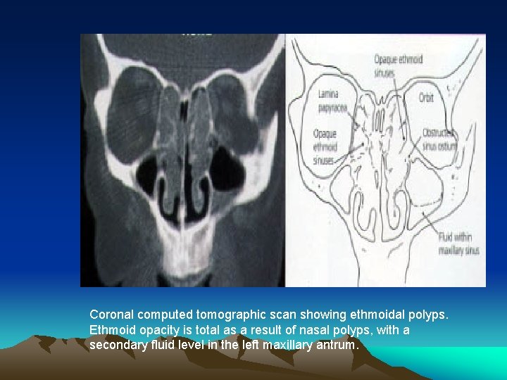 Coronal computed tomographic scan showing ethmoidal polyps. Ethmoid opacity is total as a result