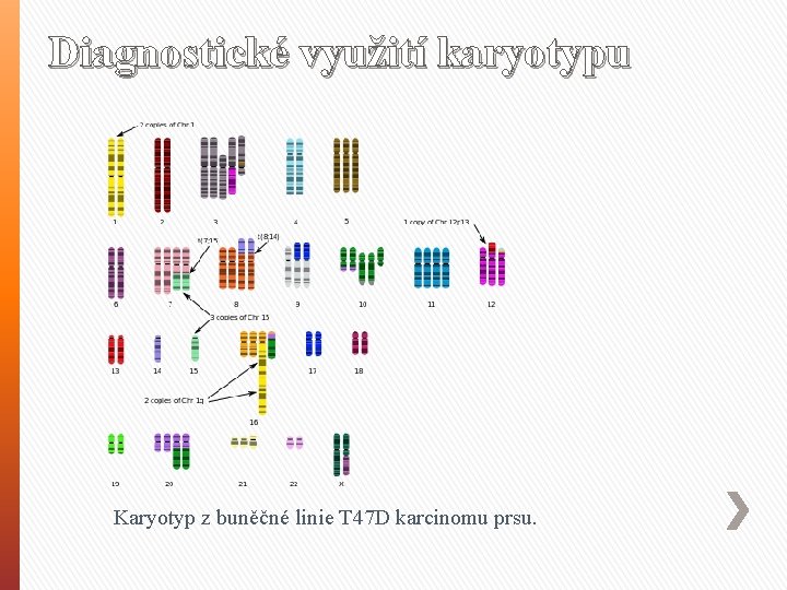 Diagnostické využití karyotypu Karyotyp z buněčné linie T 47 D karcinomu prsu. 