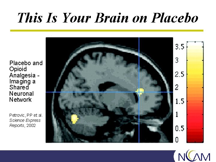 This Is Your Brain on Placebo and Opioid Analgesia Imaging a Shared Neuronal Network