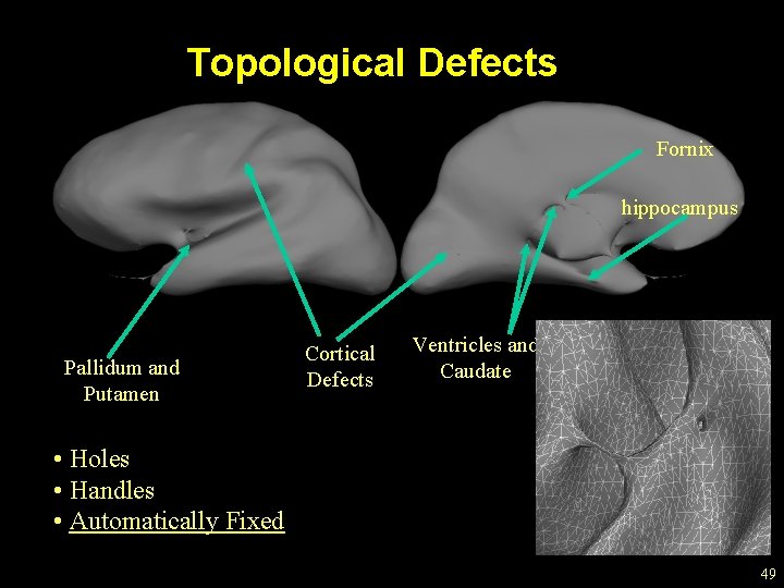 Topological Defects Fornix hippocampus Pallidum and Putamen Cortical Defects Ventricles and Caudate • Holes