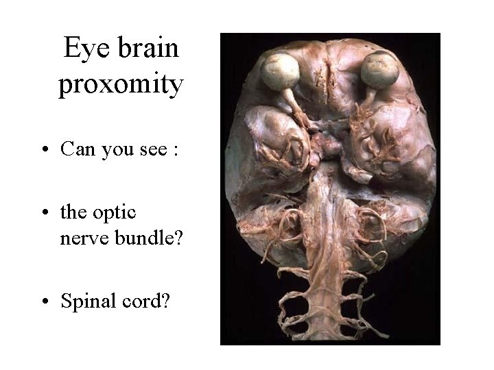 Eye brain proxomity • Can you see : • the optic nerve bundle? •