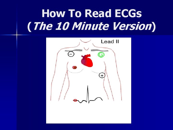 How To Read ECGs (The 10 Minute Version) 