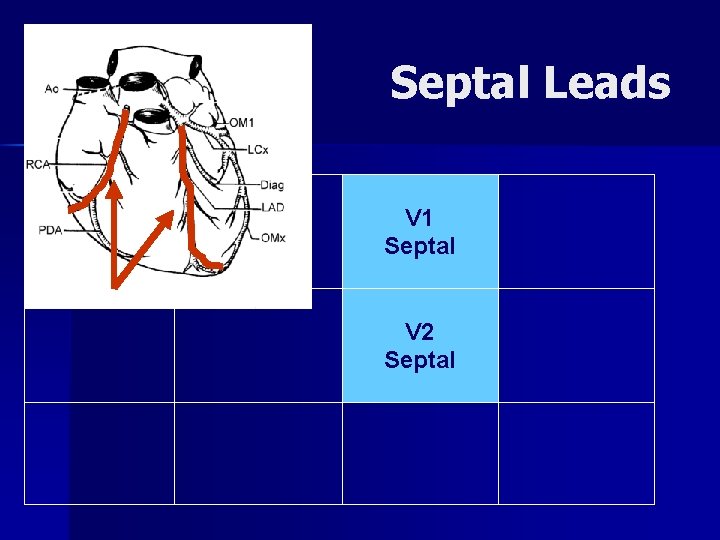 Septal Leads V 1 Septal V 2 Septal 
