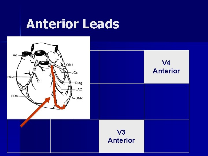 Anterior Leads V 4 Anterior V 3 Anterior 