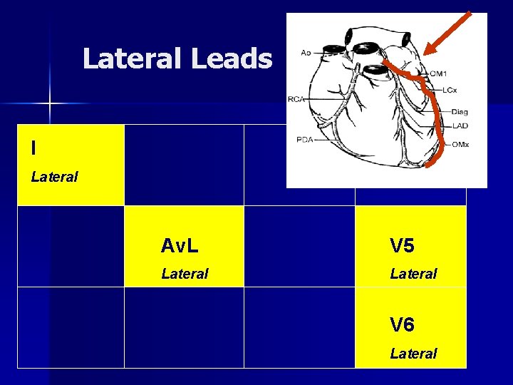 Lateral Leads I Lateral Av. L V 5 Lateral V 6 Lateral 