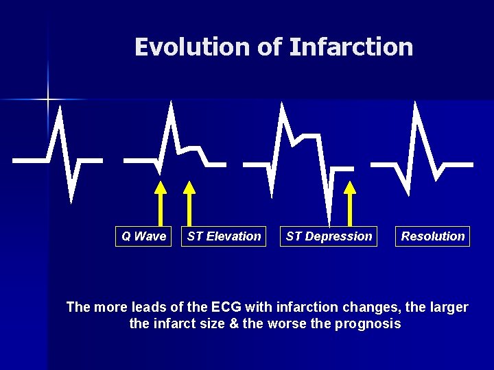 Evolution of Infarction Q Wave ST Elevation ST Depression Resolution The more leads of