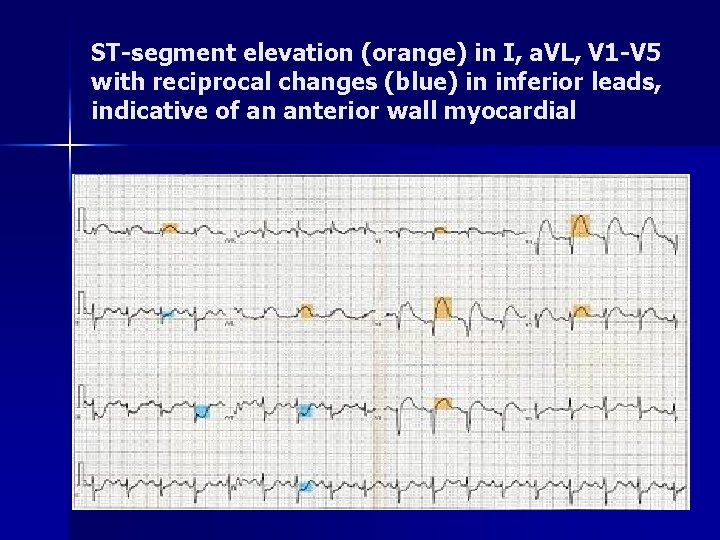 ST-segment elevation (orange) in I, a. VL, V 1 -V 5 with reciprocal changes