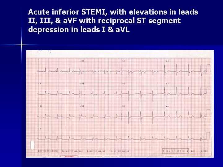 Acute inferior STEMI, with elevations in leads II, III, & a. VF with reciprocal