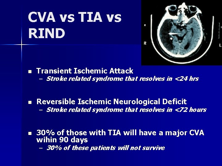 CVA vs TIA vs RIND n Transient Ischemic Attack n Reversible Ischemic Neurological Deficit