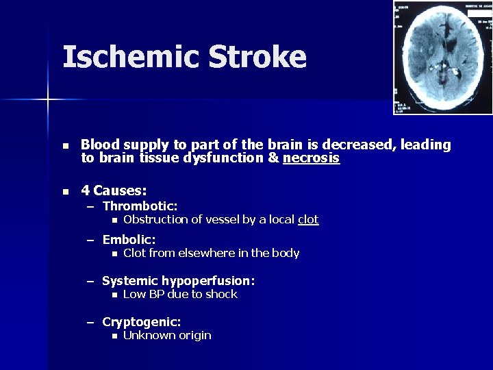 Ischemic Stroke n Blood supply to part of the brain is decreased, leading to