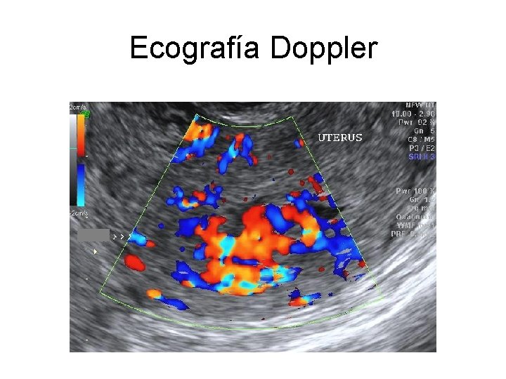 Ecografía Doppler 