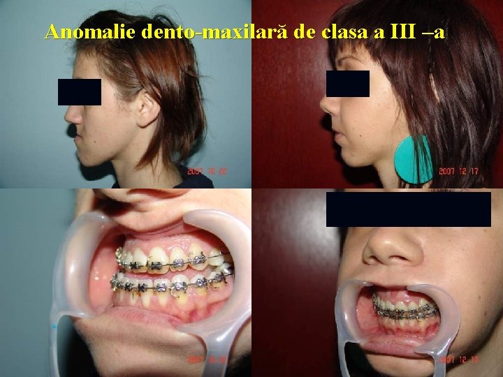Anomalie dento-maxilară de clasa a III –a 
