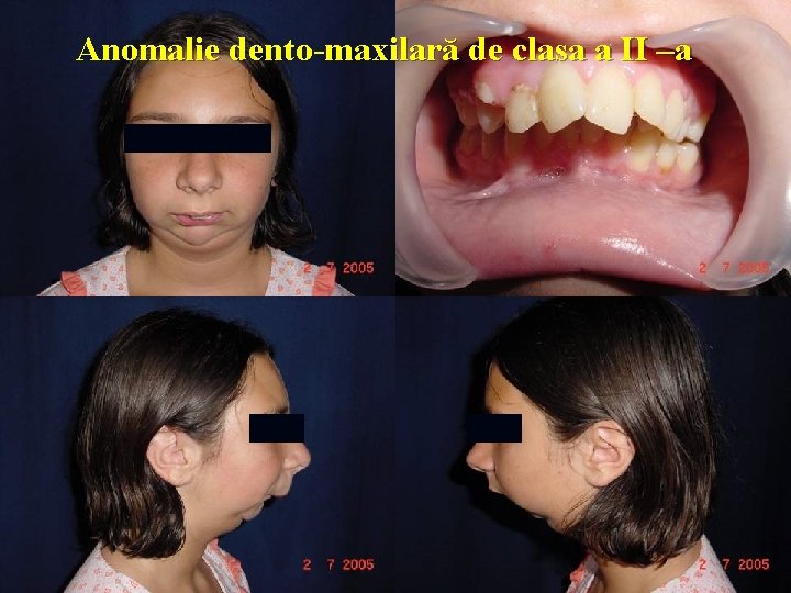 Anomalie dento-maxilară de clasa a II –a 