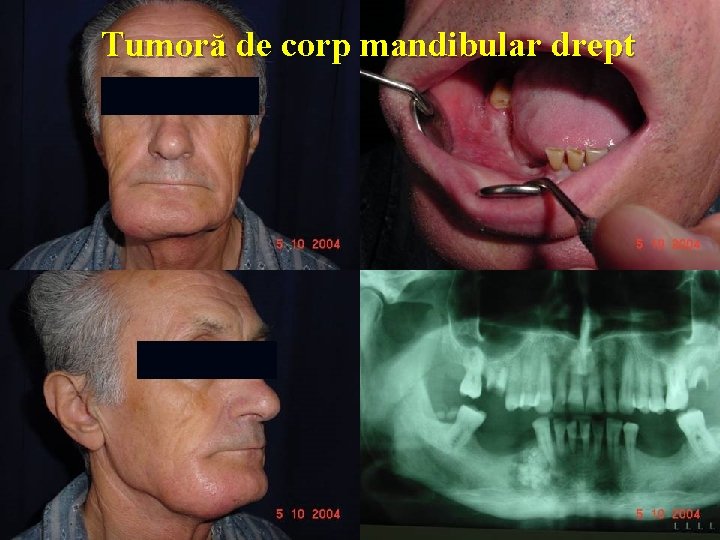 Tumoră de corp mandibular drept 